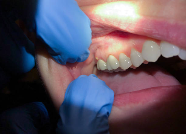 Best Emergency Tooth Extraction in Lake Mary Jane, FL