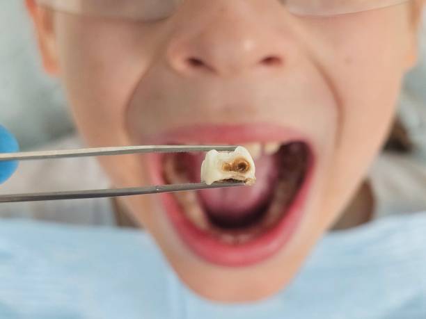 Best Emergency Treatment for Dental Infections or Abscesses in Lake Mary Jane, FL